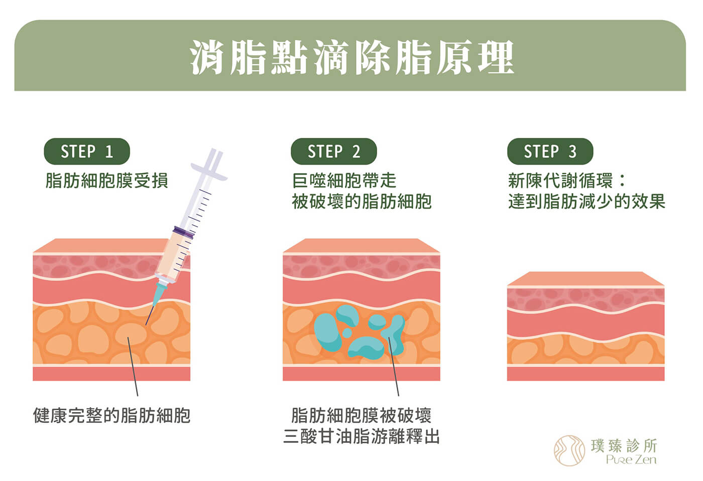 消脂點滴減重特點：代謝中性脂肪和膽固醇。消脂點滴（燃脂點滴）的多項成分，可代謝中性脂肪和膽固醇，研究證實多烯磷脂醯膽鹼，可誘導脂肪細胞凋亡，並且不破壞其他細胞組織。消脂點滴透過靜脈注射，破壞脂肪細胞膜將其乳糜化分解，被巨噬細胞回收至新陳代謝循環，達到幫助代謝、保護內臟的作用。