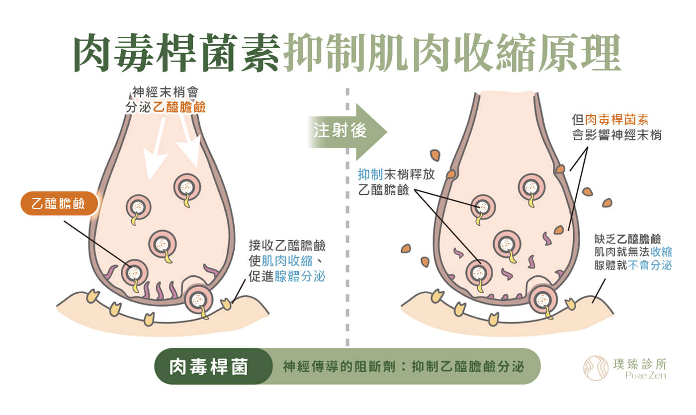 胃肉毒治療原理，放鬆胃部肌肉減緩消化：腸胃蠕動過快、過慢都會對身體帶來負擔，現代人壓力大影響自律神經，容易引起腸胃蠕動失調的問題。胃肉毒的治療原理是將肉毒桿菌素注射於胃部平滑肌，暫時抑制使肌肉收縮的乙醯膽鹼，阻礙神經末梢的肌肉傳導、使肌肉放鬆。