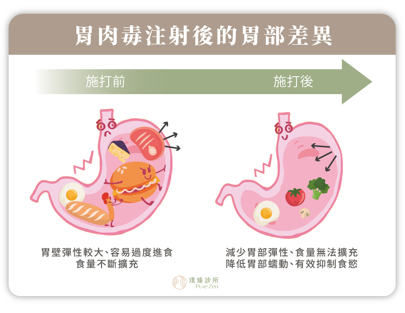 什麼是胃肉毒注射_胃肉毒注射後的胃部差異