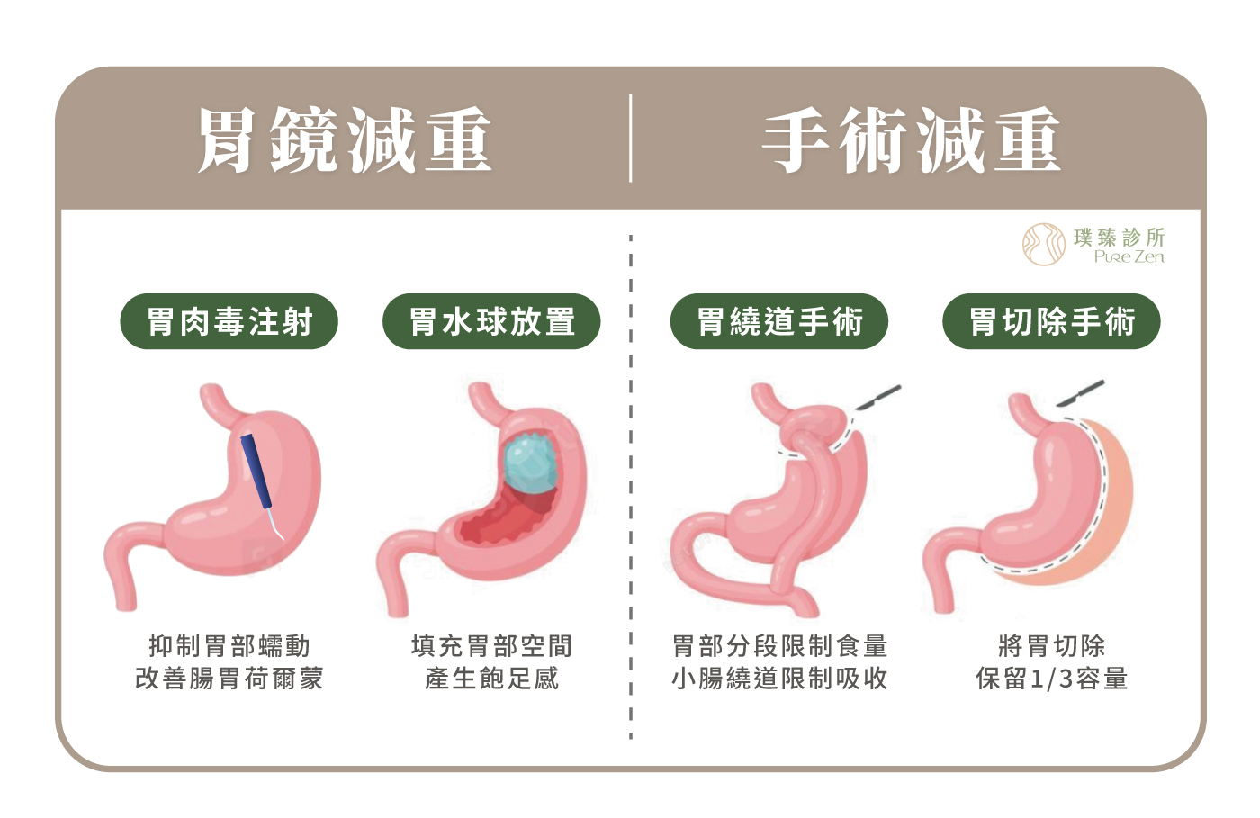 常見胃部減重手術療程差異，全球肥胖率不斷升高，輔佐減肥的技術也日新月異，目前已有多種胃部的減重及代謝手術，璞臻診所特別列出常見之內外科「胃部減重療程(胃肉毒注射、胃水球放置、胃縫合治療、胃繞道手術、胃切除手術)」，幫您彙整各個療程的優缺點及差異性，作為與專業醫師諮詢時的溝通參考。