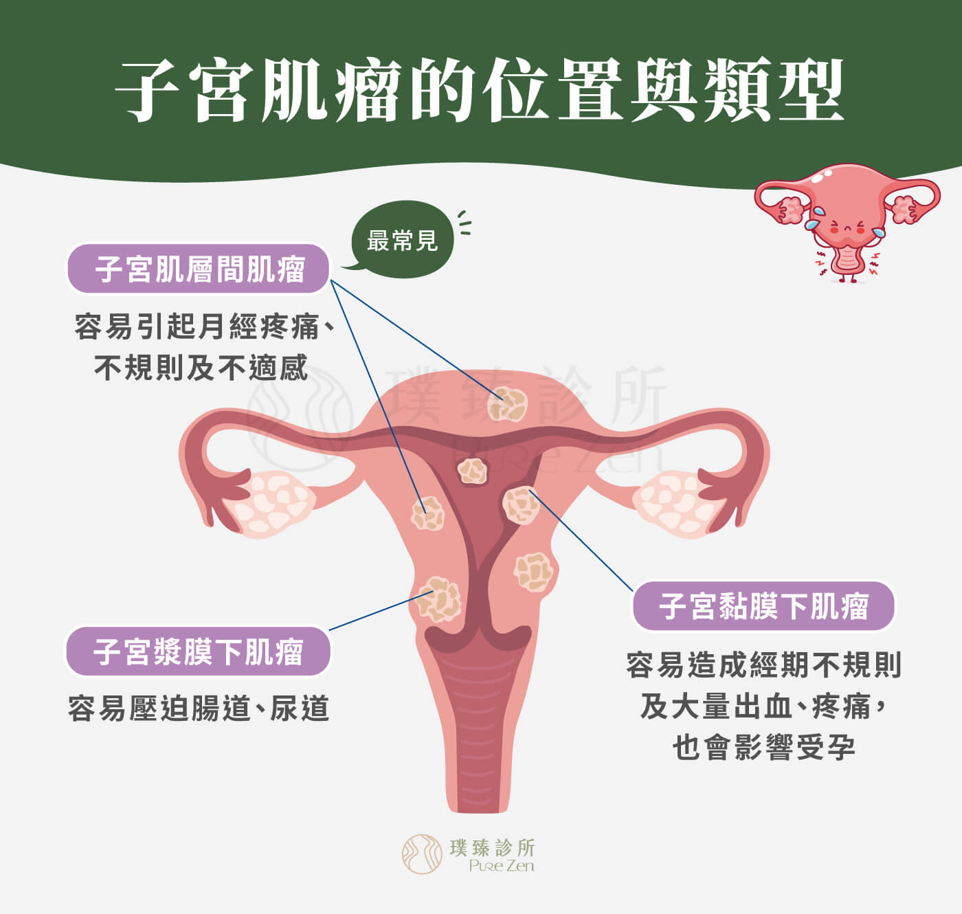 子宮肌瘤(Uterine Fibroids)生長在骨盆腔,是由子宮平滑肌細胞異常增生而形成的平滑肌瘤(纖維瘤)。根據其生長位置,子宮肌瘤可以分為三大種類。(1)子宮漿膜下肌瘤:位於子宮外側骨盆腔或腹腔突出生長,肌瘤體積較大,容易壓迫腸道、尿道。(2)子宮肌層間肌瘤:位於子宮壁及肌肉組織內,是最常見的肌瘤部位,容易引起月經疼痛、不規則及不適感。(3)子宮黏膜下肌瘤:位於子宮內膜下層往子宮腔生長,容易造成經期不規則及大量出血、疼痛,也會影響受孕。 子宮肌瘤的位置與類型_子宮漿膜下肌瘤_子宮肌層間肌瘤_子宮黏膜下肌瘤