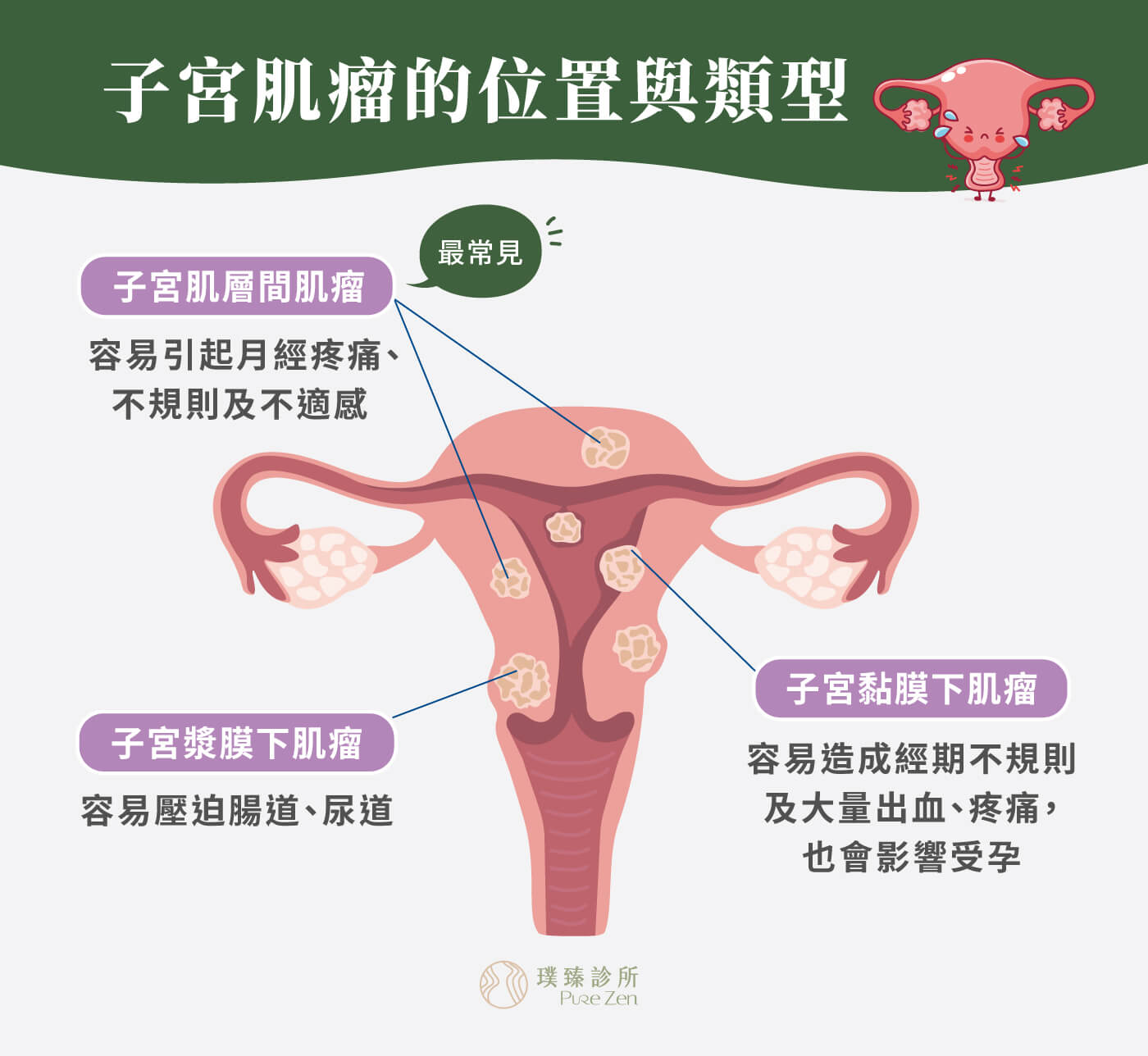 子宮肌瘤的位置與類型_子宮漿膜下肌瘤_子宮肌層間肌瘤_子宮黏膜下肌瘤