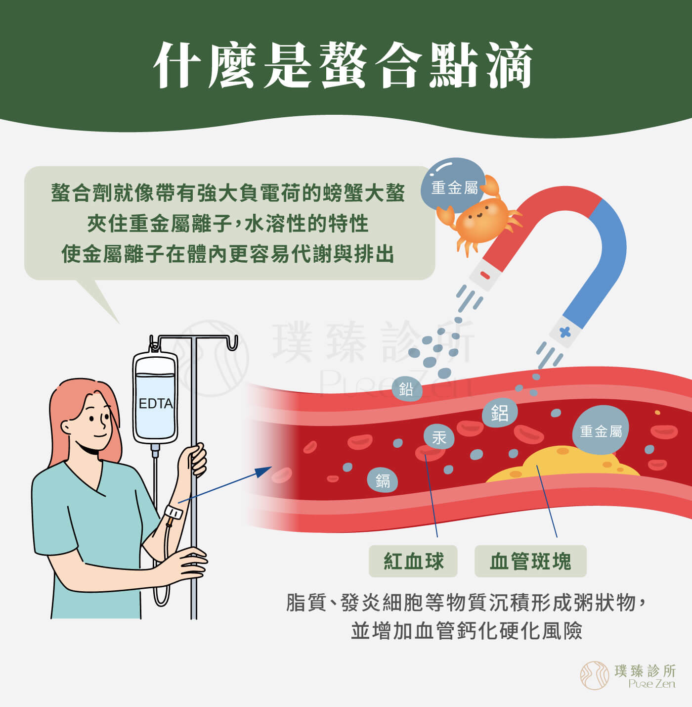 什麼是螯合點滴? 重金屬汙染透過空氣、皮膚接觸及飲食進入人體,增加氧化壓力、分泌發炎因子,目前已有許多案例發現某些高金屬污染風險的個案,罹癌並且尿液檢測有重金屬超標的狀況。建議與腫瘤科醫師溝通,持續原有化療放療等免疫療法,針對重金屬的排除,可搭配螯合療法及高劑量維他命C點滴,排除體內過多的重金屬毒素,並降低體內的氧化壓力、補充個案所需營養。 發現癌症及體內重金屬含量超標_什麼是螯合點滴
