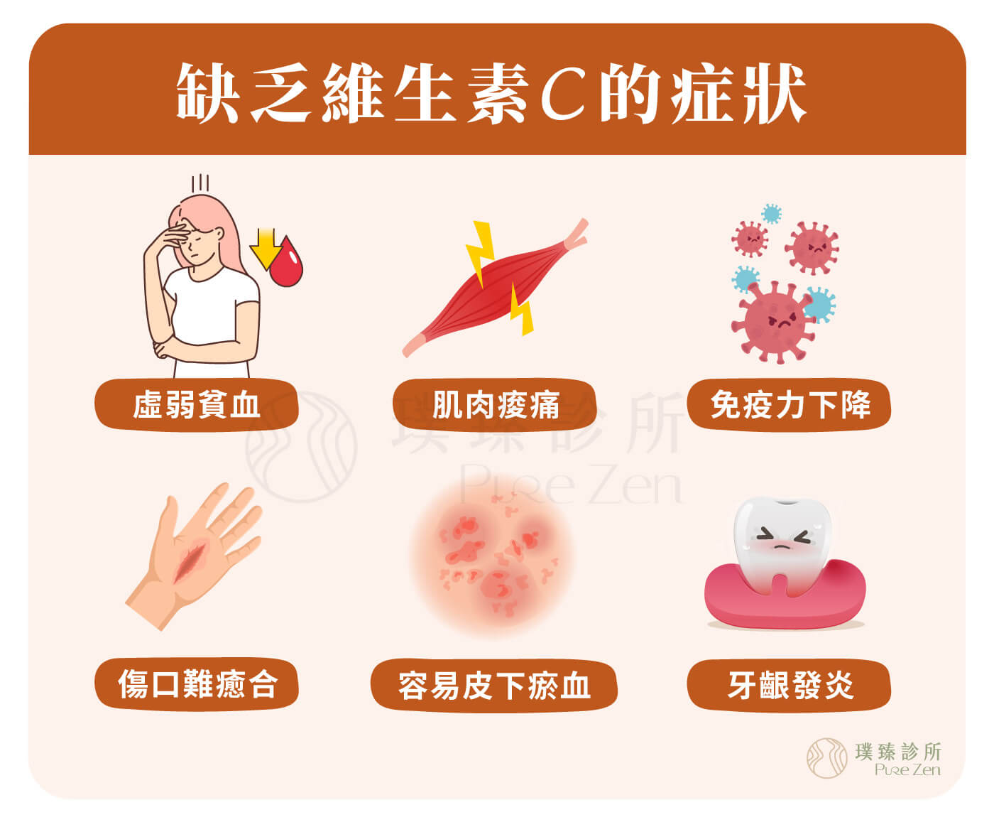 現代人生活型態改變,高壓力、不良習慣及環境會快速的消耗代謝體內的維生素C,缺乏維他命C容易出現傷口癒合不良、抵抗力差、容易感染,甚至是出血、疼痛紅腫、壞血症、精神病變等問題。 缺乏維生素C的症狀_為什麼需要高單位維他命C