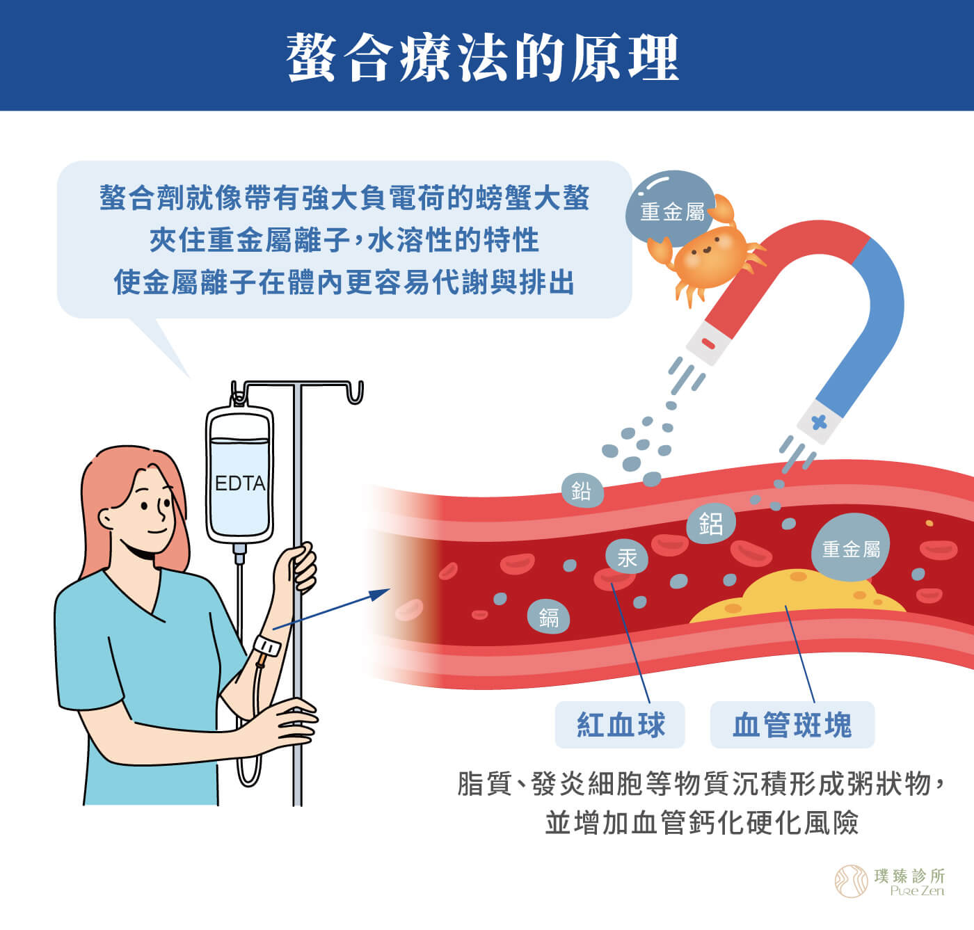 螯合療法的原理,螯合作用(Chelation)指的是胺基酸螯合劑進入人體細胞粒線體的化學反應,在骨骼、肝臟、膵臟、腎臟、腦部、血中流通的鉛使其沉澱,螯合劑就像帶有強大負電荷的螃蟹大螯夾住重金屬離子,形成穩定的環狀結構,其水溶性的特性可使金屬離子在體內更容易代謝與排出。 螯合療法的作用原理_螯合劑與重金屬產生螯合作用