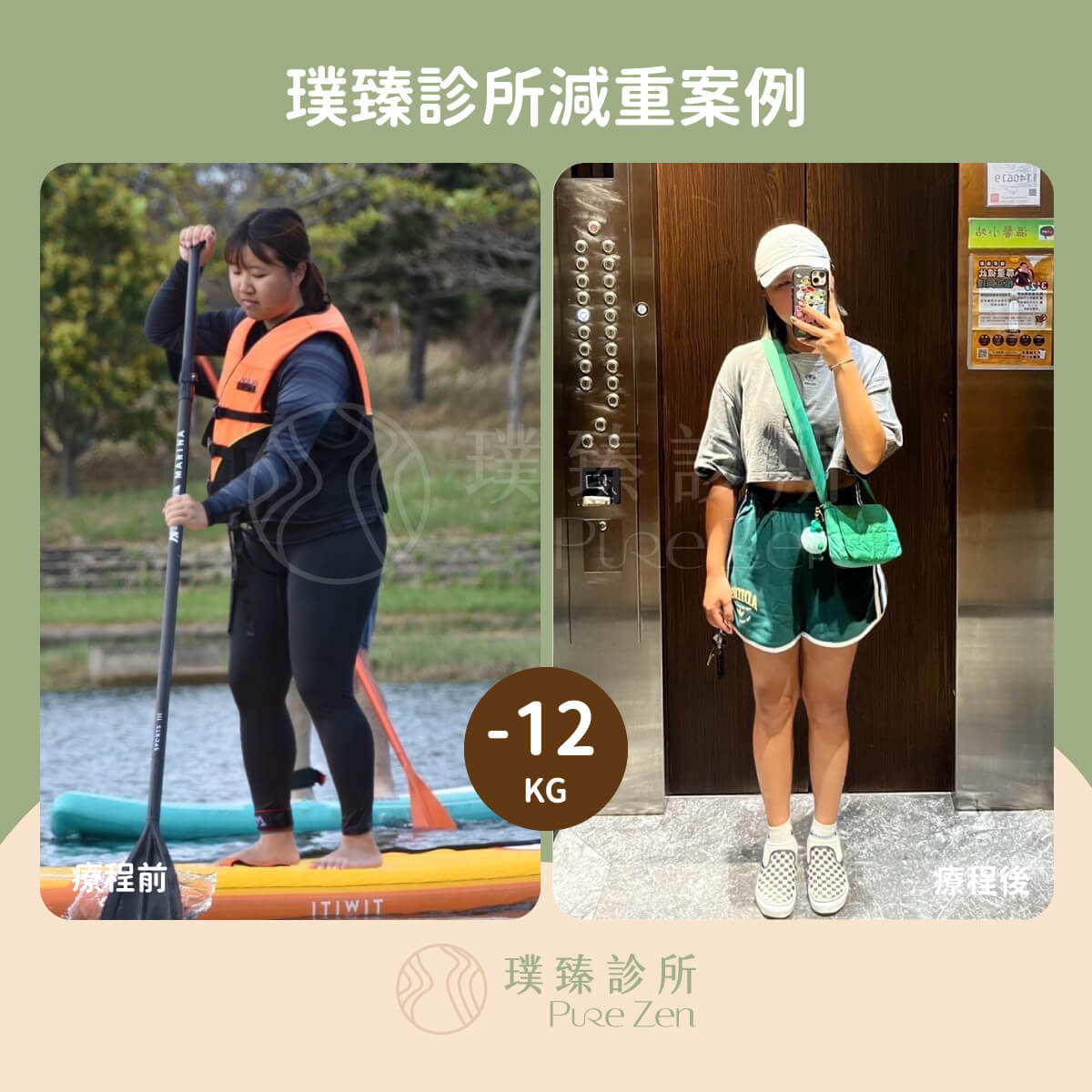 胃鏡減重案例-成功減重12公斤 胃鏡減重案例-成功減重12公斤