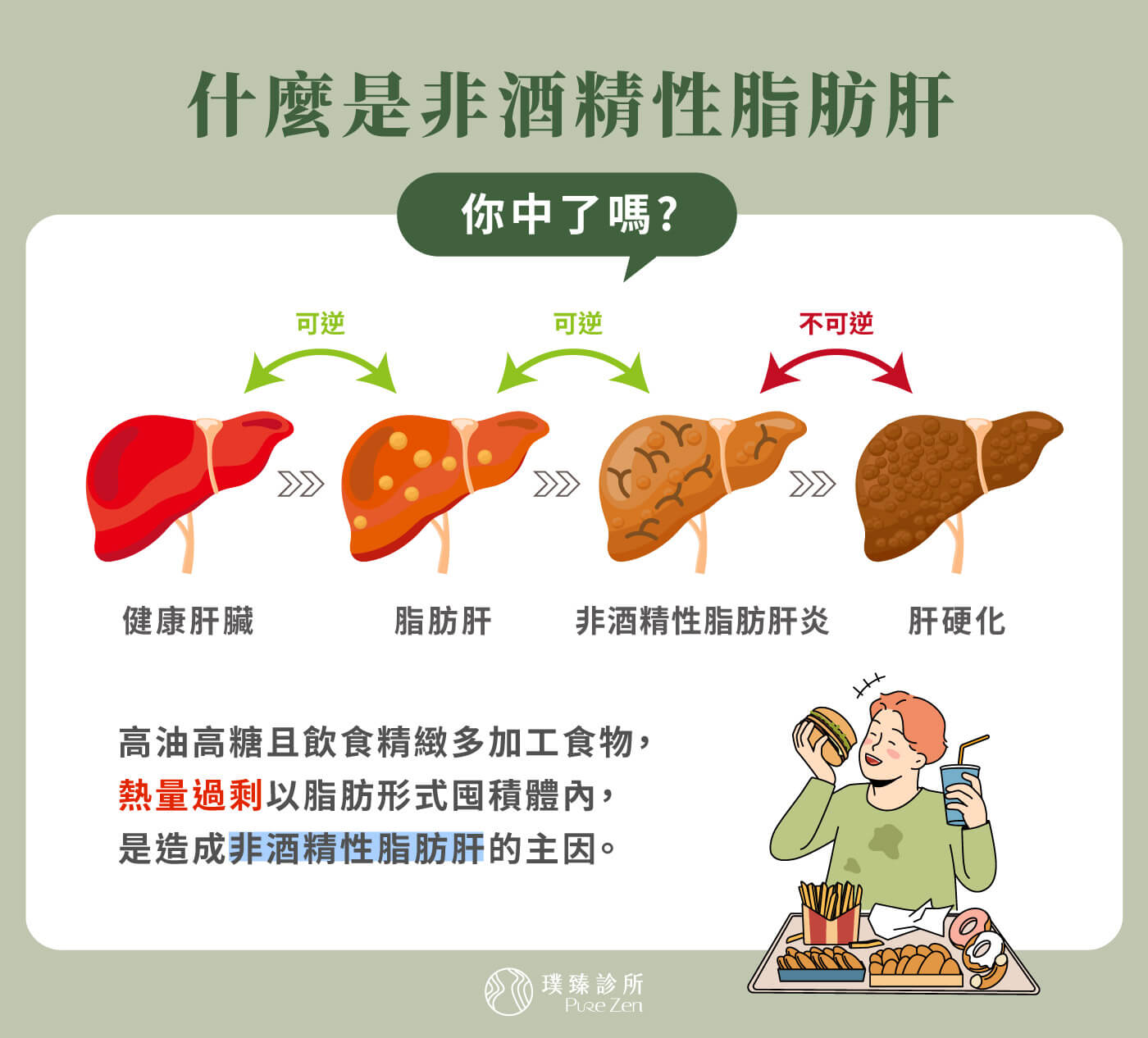精緻飲食、肥胖引發的非酒精性脂肪肝,雖較少引發猛爆性肝炎,但作息不當如長期熬夜、睡眠不足仍可能讓肝指數飆升造成急性肝炎,亦有可能造成心血管疾病;若本身有病毒肝炎或用藥肝損傷而不自知,仍有可能併發猛爆性肝炎。 什麼是非酒精性脂肪肝