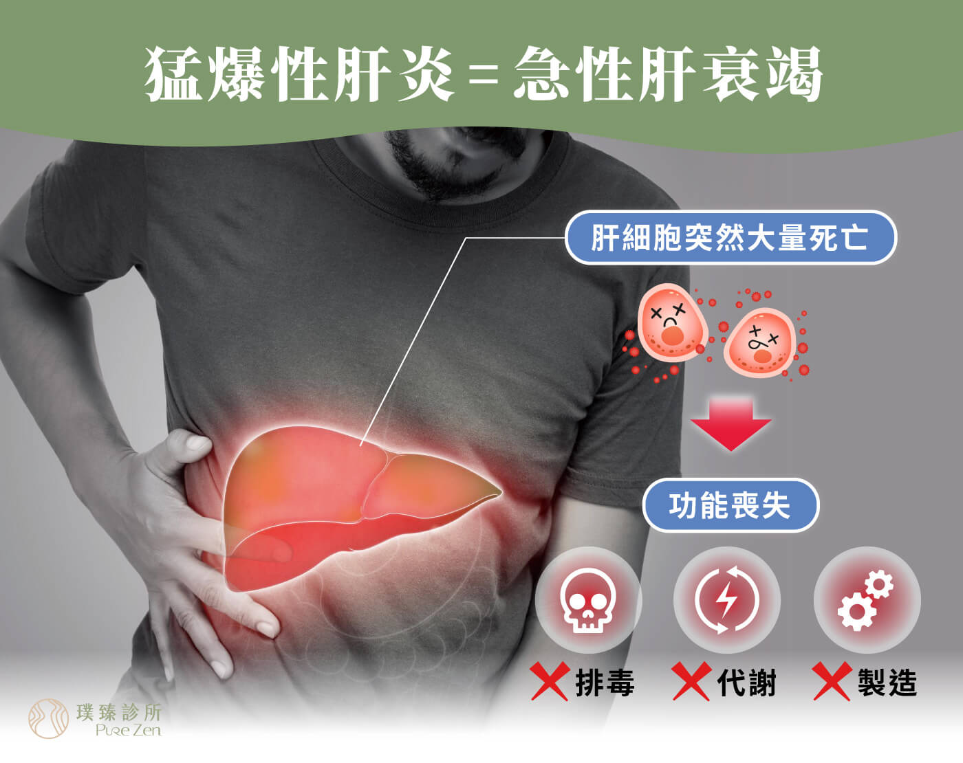 猛爆性肝炎_ 急性肝衰竭Acute liver failure