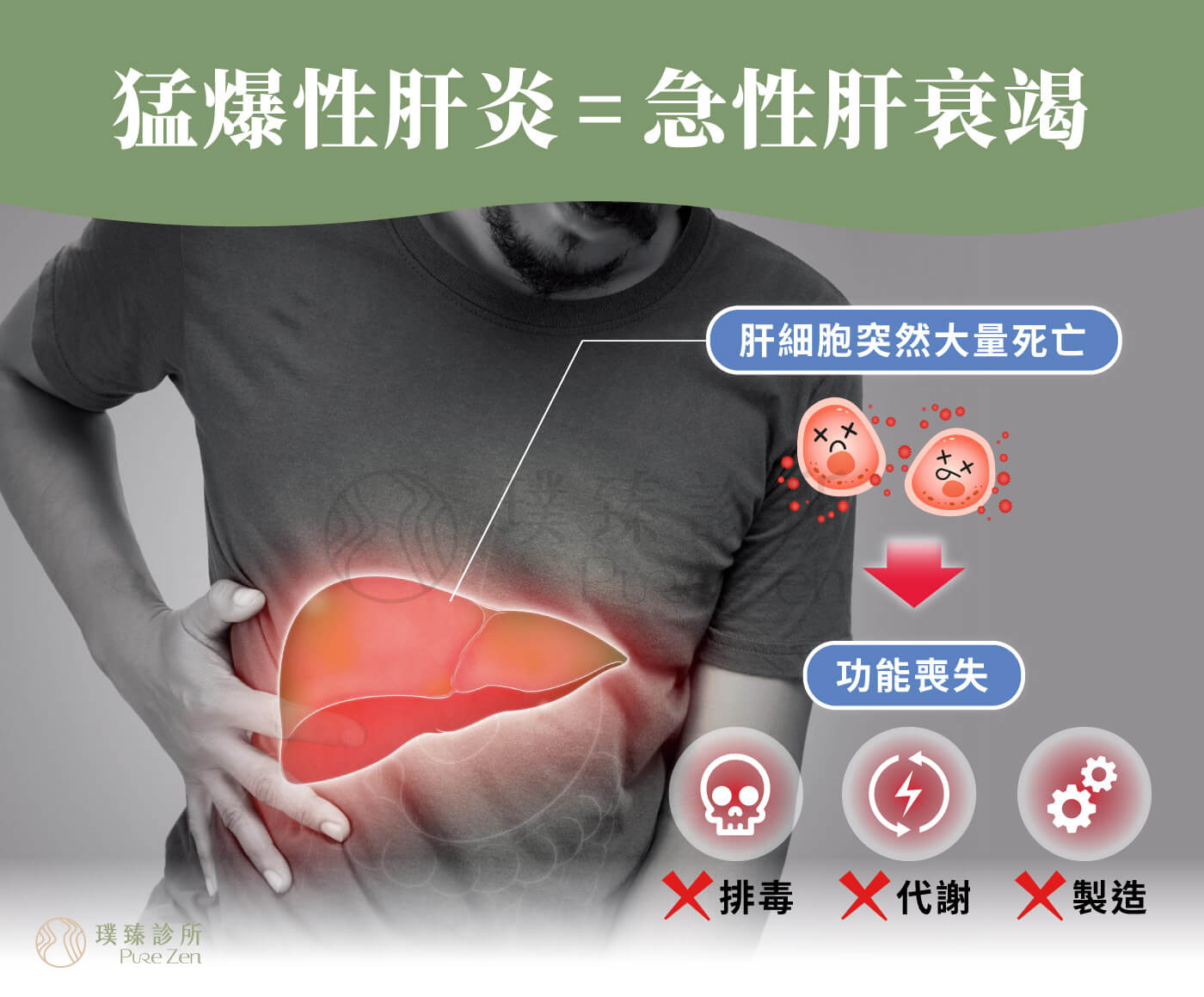猛爆性肝炎_-急性肝衰竭Acute-liver-failure