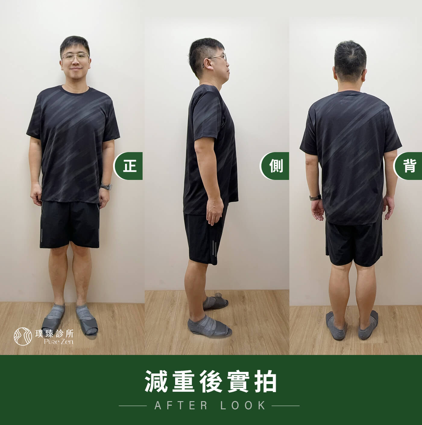 減重案例-壓力型肥胖-三階段減重策略,整個減重過程規劃為三個階段,歷時半年多,讓身體逐步適應改變。初期重點在於穩定代謝與降低內臟脂肪,讓身體不再處於高度發炎與壓力狀態。隨著食慾穩定,暴食衝動明顯下降。中期著重於體脂下降與胰島素阻抗改善,體力與精神狀態逐漸回升,血糖數據也趨於穩定。後期則建立可長期維持的生活與飲食模式,不再依賴意志力硬撐,而是身體自然不想亂吃、不容易復胖。 減重案例-壓力型肥胖-三階段減重策略