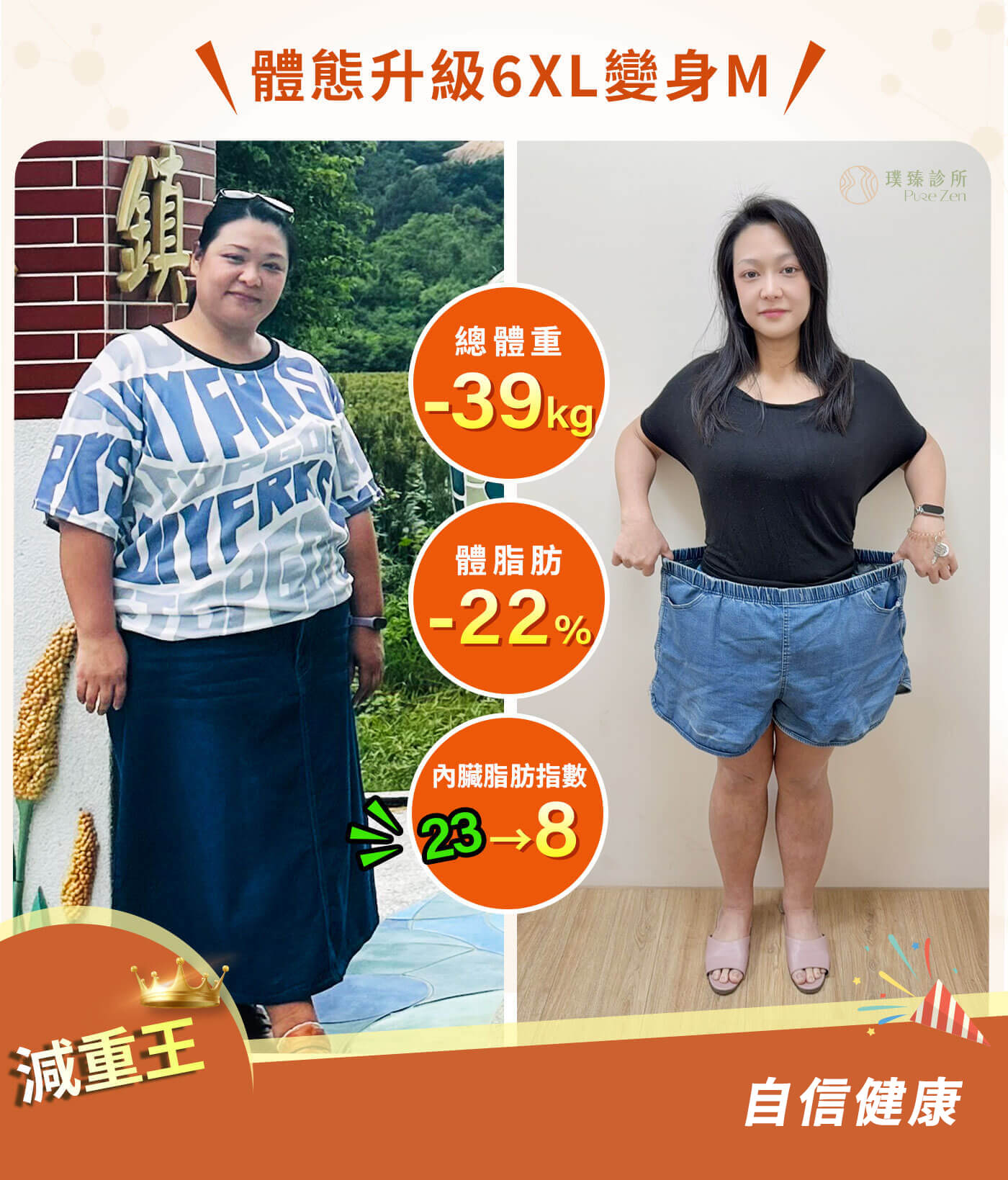 九年糖尿病逆轉糖化血色素,從33歲確診糖尿病後,長期需要使用血糖藥物,這次成功減重後,糖化血色素從 8.7 降到 5.6,代謝科醫師看到成果後也感到驚訝,並開始進行糖尿病用藥減量與停藥評估。 06-減重後BA2_0 (1)