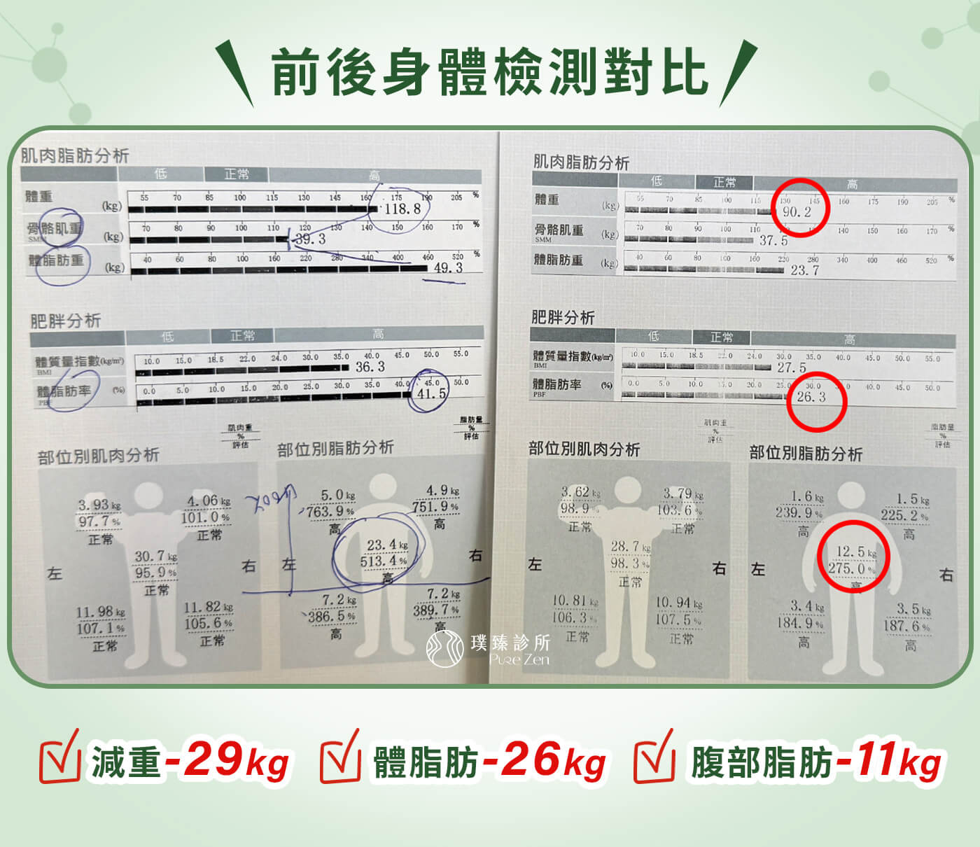減重案例-壓力型肥胖-減重成果擺脫內臟脂肪,經過半年多的減重門診療程後,熊先生的身體出現明顯改變。體重從 119 公斤下降至 90 公斤,總共減下 29 公斤;體脂肪下降約 15%;內臟脂肪指數從破表的 21,改善至 10。更重要的是,血糖與胰島素相關指標明顯改善,身體發炎狀況降低,精神與體力大幅提升。 減重案例-壓力型肥胖-減重成果擺脫內臟脂肪