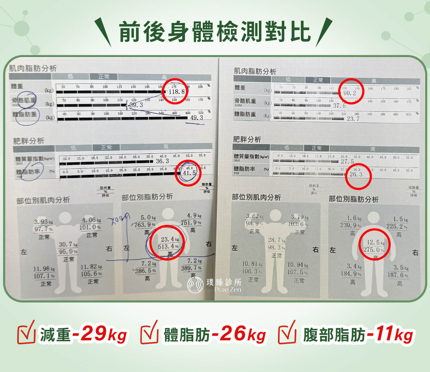 減重案例-壓力型肥胖-減重成果擺脫內臟脂肪,經過半年多的減重門診療程後,熊先生的身體出現明顯改變。體重從 119 公斤下降至 90 公斤,總共減下 29 公斤;體脂肪下降約 15%;內臟脂肪指數從破表的 21,改善至 10。更重要的是,血糖與胰島素相關指標明顯改善,身體發炎狀況降低,精神與體力大幅提升。 減重案例-壓力型肥胖-減重成果擺脫內臟脂肪