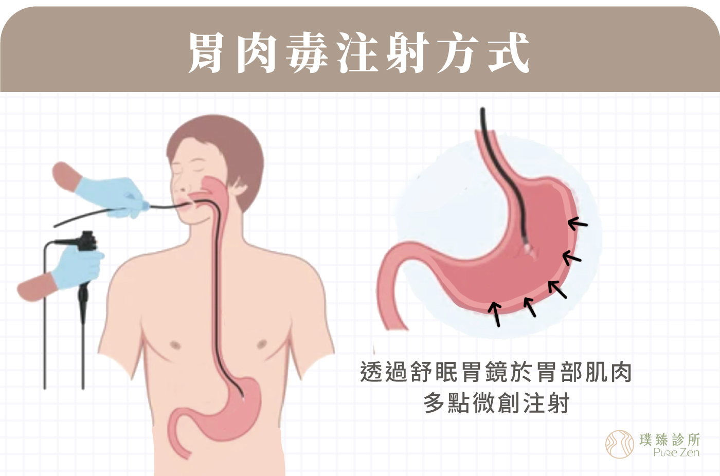 胃肉毒減重胃鏡減重_透過舒眠胃鏡於胃部肌肉多點微創注射