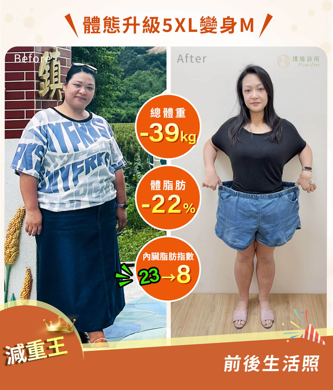 九年糖尿病逆轉糖化血色素,從33歲確診糖尿病後,長期需要使用血糖藥物,這次成功減重後,糖化血色素從 8.7 降到 5.6,代謝科醫師看到成果後也感到驚訝,並開始進行糖尿病用藥減量與停藥評估。 減重後_糖尿病減重案例_10 個月減重 39公斤_KO九年糖尿病逆轉糖化血色素
