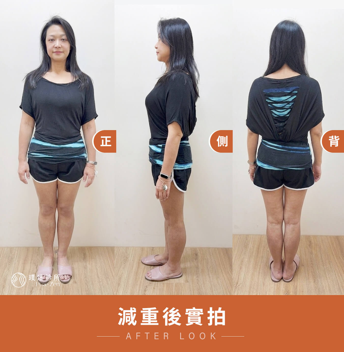 小綿的減重療程是透過醫師詳細評估後的客製化規劃,搭配猛健樂減重筆、邁爾氏點滴,調節食慾讓大腦不再充斥進食的慾望,一方面補足身體缺乏的營養成分,例如維生素C、維生素B群及鎂,幫助能量及醣類代謝,並搭配消脂成分,協助降低內臟脂肪持續釋放游離脂肪酸的荷爾蒙干擾。 減重後實拍_糖尿病減重案例_10 個月減重 39公斤_KO九年糖尿病逆轉糖化血色素