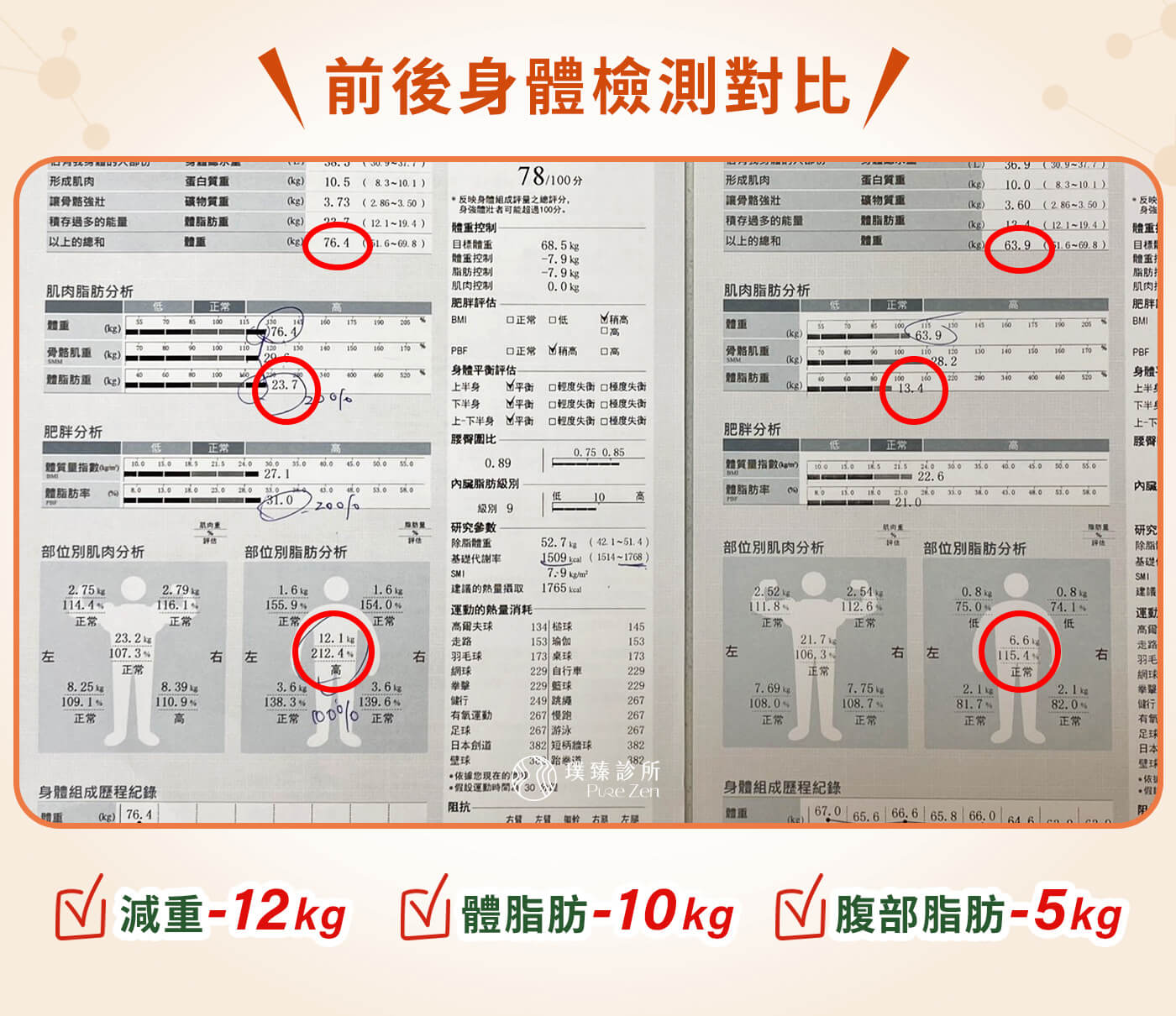 產後肥胖減重案例-減重成果- 經過 3 個多月的整合式減重門診,小柔老師擺脫產後肥胖,成功減重 12 公斤。這個成果不只是體重數字變化,體脂率從31%降到21%的正常範圍,更有感的是身形與生活狀態的改變。 產後肥胖減重案例-減重成果- 減重12公斤,從 2XL 回到 M 號